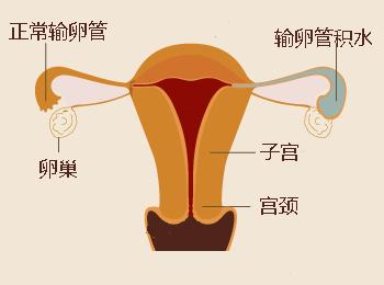 输卵管积水的原因是什么